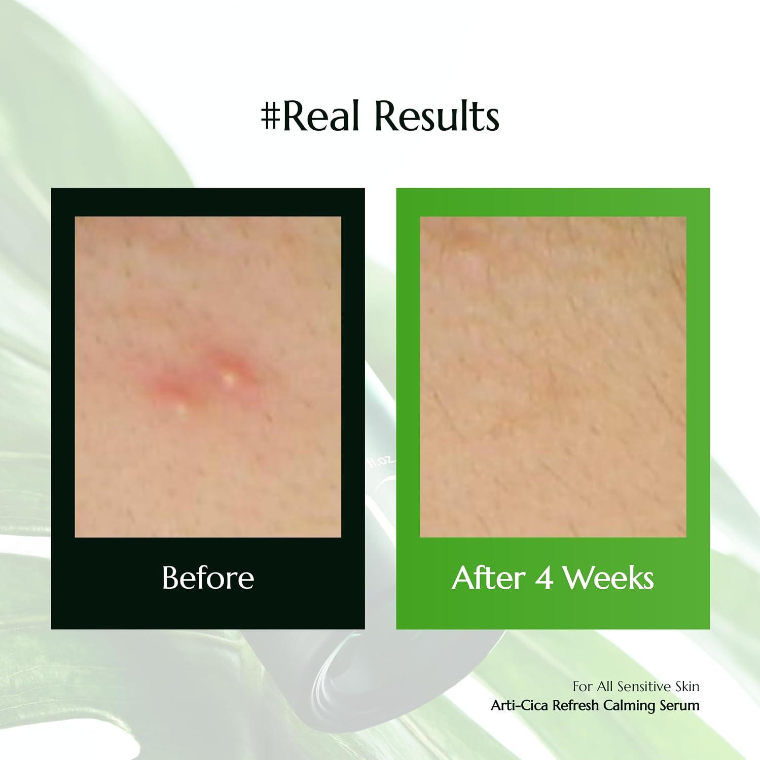 molvany Arti-Cica Refresh Calming Serum 5